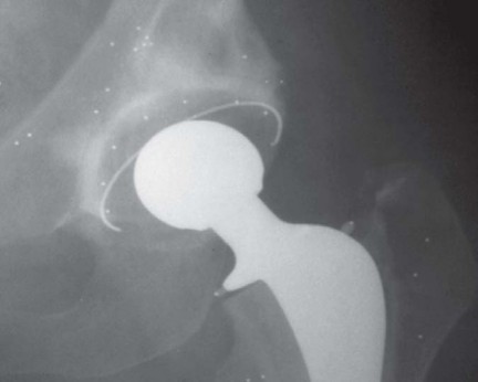 Illustration 41 for Optimizing Acetabular Component Cementation for Superior Outcomes