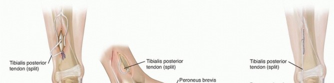 Illustration 3 for Preventing Overcorrection: Split Tibialis Posterior Tendon Transfer