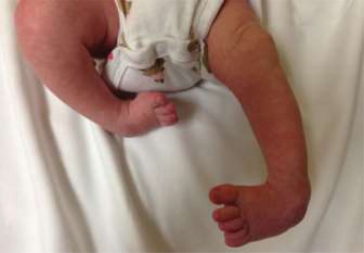 Pediatric Clubfoot Deformity: Pathoanatomy, Biomechanics, and the Role of the Anterior Tibialis Tendon