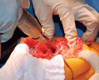 Illustration 40 for Mastering Gap Balancing in Revision TKA: Avoid Common Pitfalls