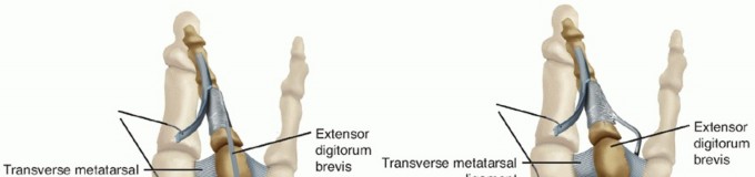 Illustration 8 for Toe Deformity Pain? Rebalance Flexor to Extensor for Relief