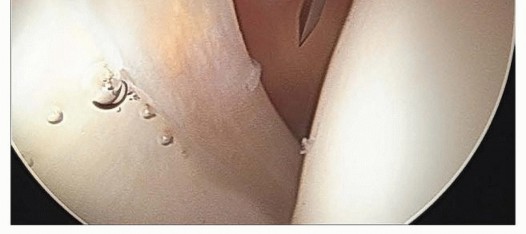 Illustration 21 for Hip Arthroscopy: Your Minimally Invasive Solution for Hip Pain