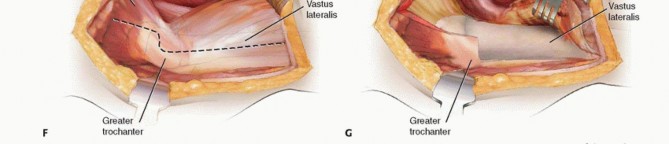 Illustration 10 for Proximal Femoral Osteotomy: When This Hip-Saving Surgery Is Performed