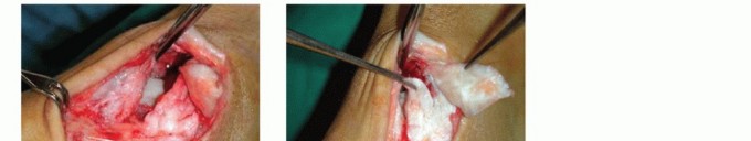 Illustration 28 for Medial Ankle Instability: Find Relief with Reconstruction