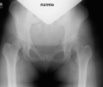 Reconstruction Cases: Solving Hip Pain & Dysplasia