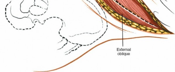 Illustration 10 for Master the Anterolateral Retroperitoneal Approach to Lumbar Spine