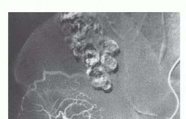 Illustration 6 for Surgical Pelvic Resection: Gluteus Maximus Muscle & Nerve Preservation