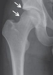 Illustration 35 for Resolving Femoral Head Neck Impingement: Arthroscopic FAI Solutions