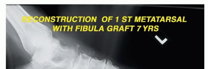 Illustration 30 for Treating Tumors of the Foot: Optimizing Amputation & Resection