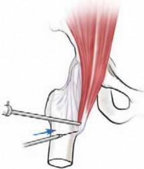Illustration 10 for J. W. Thomas on Snapping Hip: Causes, Cures & Relief