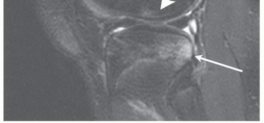 Illustration 4 for Optimizing ACL Reconstruction for Skeletally Immature Patients