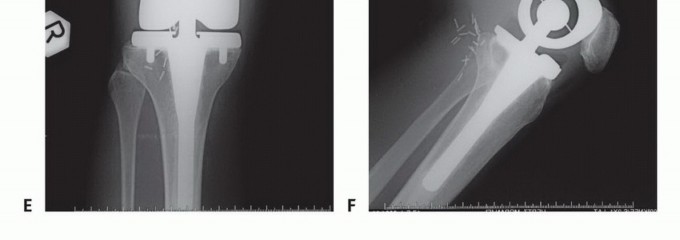 Illustration 49 for Mastering Femoral Metastases: Optimal Function for Femoris & Vastus