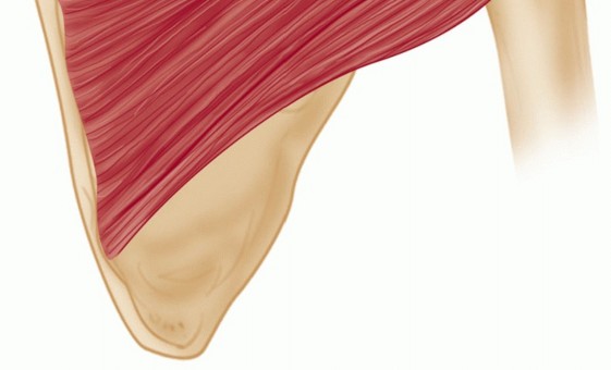 Illustration 15 for Finally Treat Recurrent Posterior Instability of the Shoulder