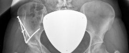 Illustration 7 for Bernese Periacetabular Osteotomy: Your Definitive Case Title Bernese