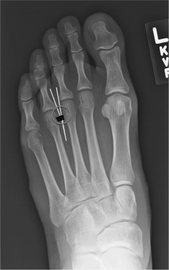 Illustration 6 for Medial Eminence Resection: Avoiding Hallux Varus & Recurrence