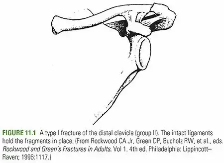 صورة توضيحية لـ كسور الترقوة: دليلك الشامل للتعافي على يد الأستاذ الدكتور محمد هطيف