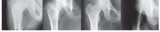 Illustration 14 for Labral Support Shelf Procedure: Preventing Perthes Deformity