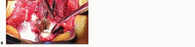 Illustration 14 for Mastering High-Grade Spondylolisthesis: Posterolateral and Interbody Fusion