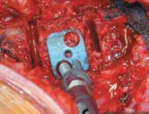 Illustration 43 for Mastering Anterior Interbody Arthrodesis with Instrumentation for Scoliosis