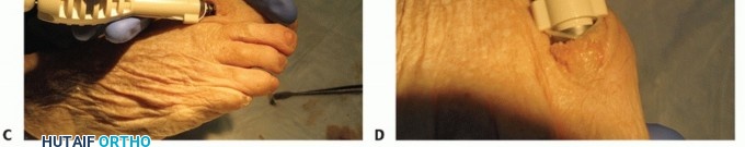 Illustration 69 for End Articular Cartilage Loss: Arthrosurface HemiCAP Resurfacing