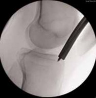Illustration 54 for Optimal Nailing of the Tibia: Techniques for Challenging Fractures