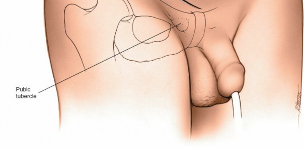 Illustration 54 for Pelvis & Acetabulum Approaches: Unlocking the Posterior Superior Iliac