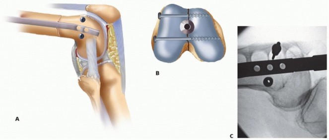 Illustration 13 for Retrograde Femoral Nailing: Optimizing Surgical Outcomes