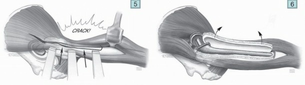 Illustration 11 for Mastering Component Removal: Extended Trochanteric Osteotomy