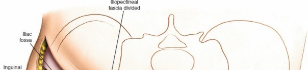 Illustration 76 for Pelvis & Acetabulum Approaches: Unlocking the Posterior Superior Iliac