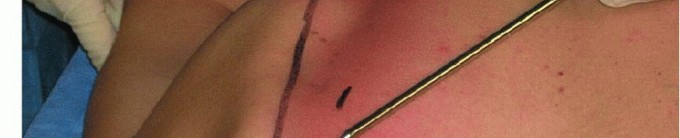 Illustration 25 for Is Your Dorsal Scapular Nerve Causing Snapping Scapula Pain?