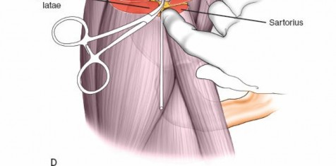 Illustration 31 for Key Approaches for External Fixation: Humerus, Radius, Ulna, Wrist