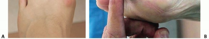 Illustration 6 for End Articular Cartilage Loss: Arthrosurface HemiCAP Resurfacing