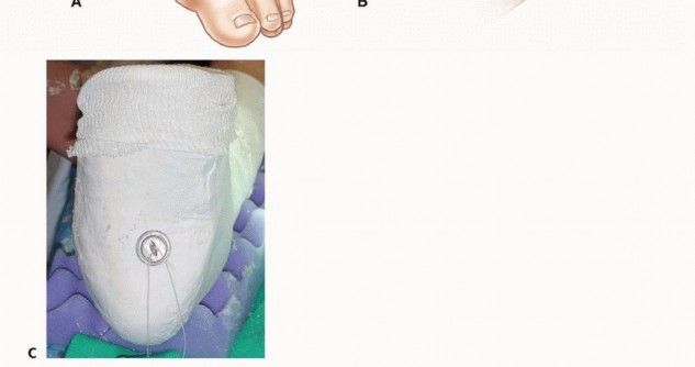 Illustration 16 for Why Anterior Tibialis Muscle Transfer Fixes Clubfoot