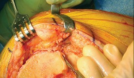 Illustration 30 for Mastering TKA: Essential Methods of Rotational Alignment