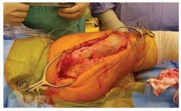 تحسين جراحة مراجعة استبدال مفصل الورك الكلي بسيقان التيتانيوم المدببة ذات الفلوس: دليل شامل للمرضى مع الأستاذ الدكتور محمد هطيف