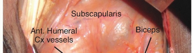 Illustration 29 for Restore Shoulder Function with Latissimus Dorsi Tendon Transfer