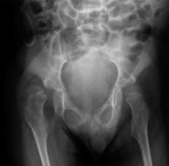 Mastering GMFCS for children with cerebral palsy: Case 37 insights