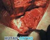 Illustration 23 for FAI: Impingement and Surgical Dislocation Explained