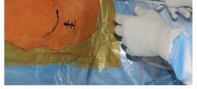 Illustration 14 for Achieve Optimal Femoral Head Fixation with Cephalomedullary Nailing