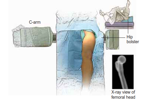 Illustration 6 for Knee Arthrodesis: A Lifelong Knee Solution for Trauma & TKA