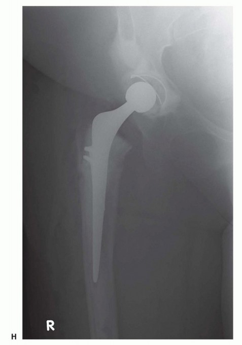 Illustration 42 for Special THA Techniques for Severe Deformities Around the Hip