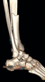 Illustration 8 for Complex Tibial Shaft Fracture: Plate Fixation for Plafond Extension