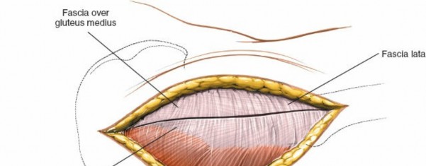 Illustration 119 for Pelvis & Acetabulum Approaches: Unlocking the Posterior Superior Iliac