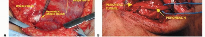 Illustration 15 for Beyond Amputation: The Type I Resection in Fibular Tumor Surgery