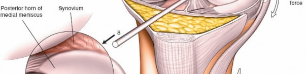 Illustration 18 for Mastering Knee Arthroscopy Approaches: Safely Withdraw the Arthroscope