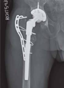 Illustration 23 for THA for patients with proximal femoral deformity: Practical solutions