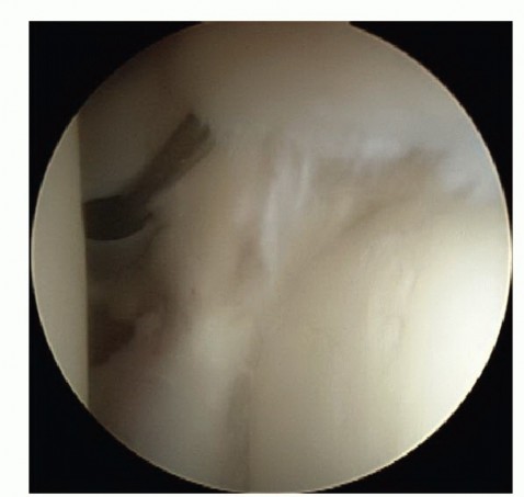 Heal Your Superior Labral Anterior Tear: Arthroscopic Treatment Guide