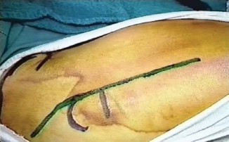 Illustration 3 for Standard Trochanteric Osteotomy: Key to Complex Hip Cases