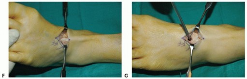 Illustration 38 for Restore Movement: Tendon Transfer for Common Peroneal Nerve Foot Drop