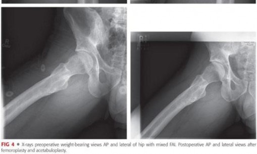 Illustration 14 for Precision Hip Arthroscopy: Unlock Access to the Peripheral Compartment